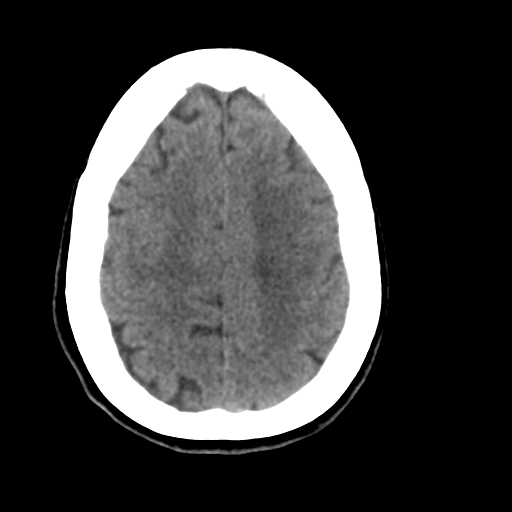 Central neurocytoma (Radiopaedia 65317-74346 Axial non-contrast 39).png