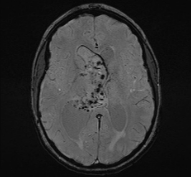 Central neurocytoma (Radiopaedia 70263-80336 Axial SWI 31).jpg