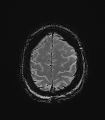File:Central neurocytoma (Radiopaedia 71068-81303 Axial SWI 58).jpg