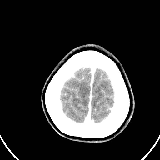 Central neurocytoma (Radiopaedia 84497-99871 B 46).jpg