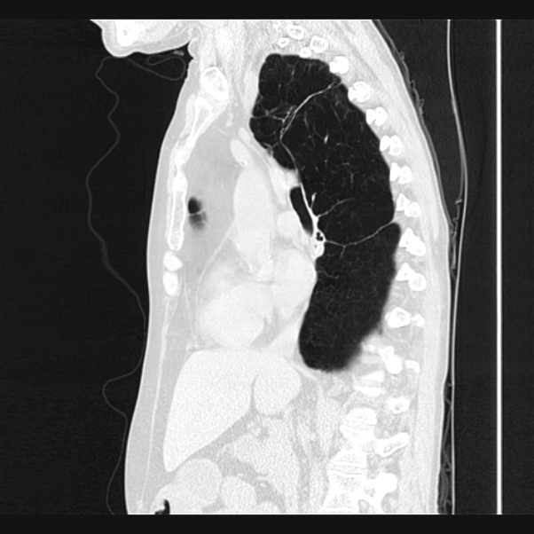Centrilobular pulmonary emphysema (Radiopaedia 24495-24789 Sagittal lung window 38).jpg