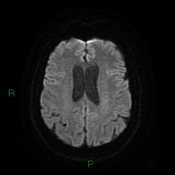 Cerebellar abscess (Radiopaedia 78135-90678 Axial DWI 20).jpg