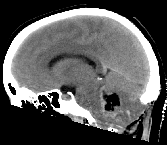 File:Cerebellar ependymoma complicated by post-operative subdural hematoma (Radiopaedia 83322-97737 C 16).png