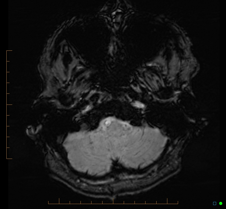 Cerebellar gangliocytoma (Radiopaedia 65377-74422 Axial SWI 6).jpg