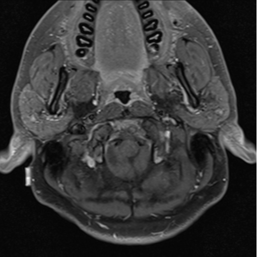 File:Cerebellar hemangioblastomas and pituitary adenoma (Radiopaedia 85490-101176 Axial T1 C+ fat sat 3).png