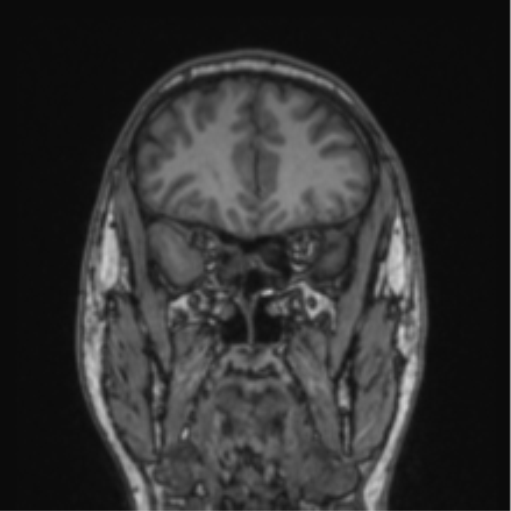 Cerebellar hemangioblastomas and pituitary adenoma (Radiopaedia 85490-101176 Coronal T1 67).png