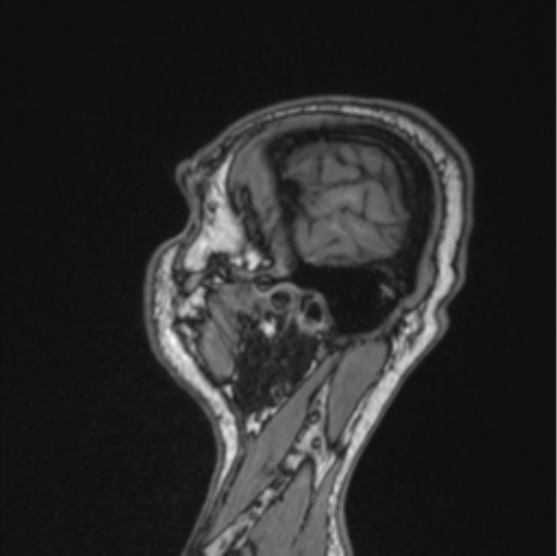 Cerebellar hemangioblastomas and pituitary adenoma (Radiopaedia 85490-101176 Sagittal T1 24).png