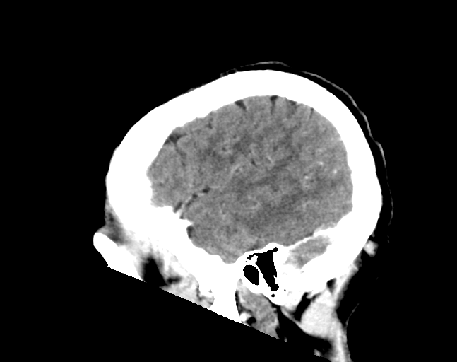 File:Cerebellar hemorrhage (Radiopaedia 37000-38671 Sagittal C+ 8).png