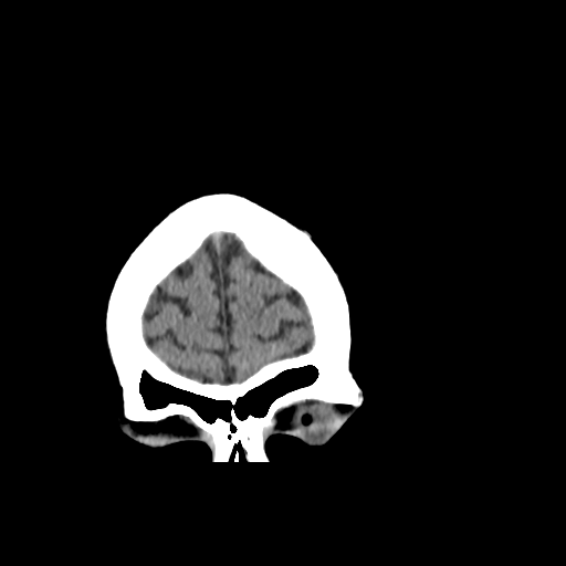 File:Cerebellar infarct due to vertebral artery dissection with posterior fossa decompression (Radiopaedia 82779-97029 Coronal non-contrast 5).png