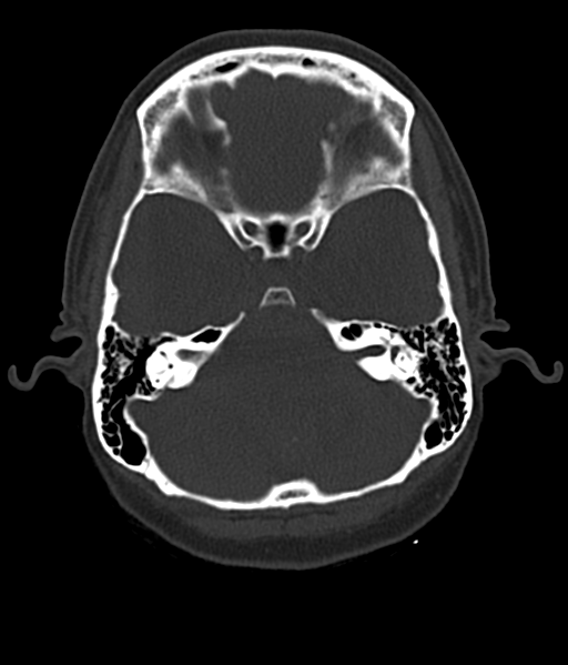 File:Cerebellar metastases - colorectal adenocarcinoma (Radiopaedia 40947-43652 AX Bone C- 2.0 MPR 14).png