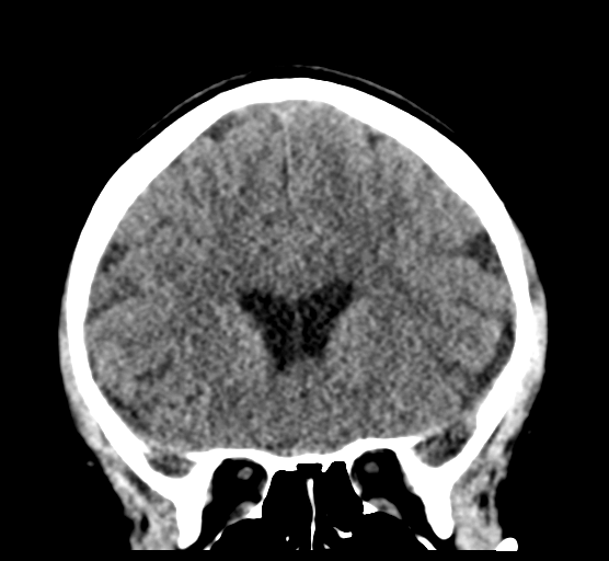 Cerebellar metastases - colorectal adenocarcinoma (Radiopaedia 40947-43652 Coronal non-contrast 35).png