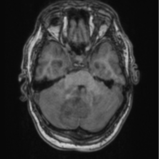 Cerebellar metastasis from lung adenocarcinoma (Radiopaedia 86690-102829 Axial T1 26).png