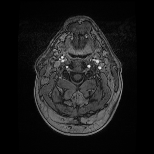 Cerebellar metastasis of pulmonary adenocarcinoma, cavernous venous malformation, and developmental venous anomaly (Radiopaedia 85827-101661 Axial T1 C+ 4).jpg