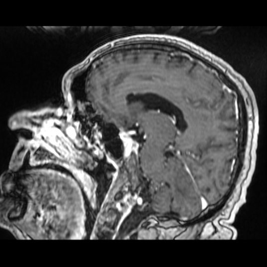 Cerebellar metastasis of pulmonary adenocarcinoma, cavernous venous malformation, and developmental venous anomaly (Radiopaedia 85827-101661 Sagittal T1 C+ 55).jpg