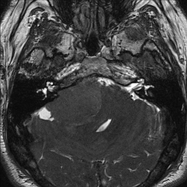 Cerebellopontine angle meningioma (Radiopaedia 24459-24764 I 22).jpg
