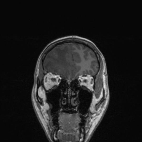 Cerebral abscess (Radiopaedia 24212-24478 Coronal T1 54).jpg