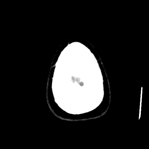 Cerebral abscess (Radiopaedia 29451-29919 Axial non-contrast 48).jpg