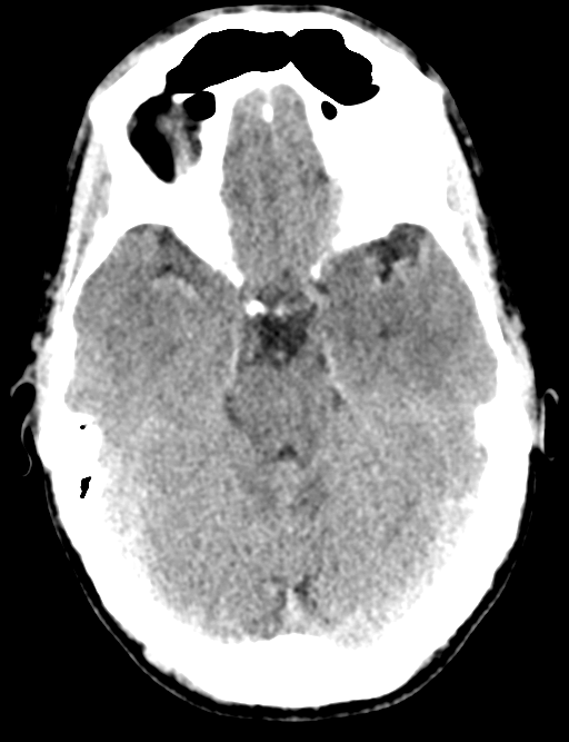 Cerebral abscess (Radiopaedia 60342-68008 Axial non-contrast 18).png