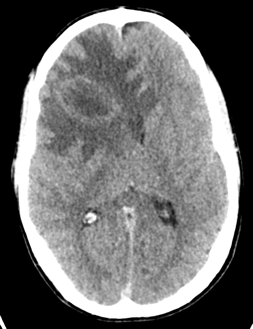 Cerebral abscess (Radiopaedia 60342-68008 Axial non-contrast 28).png