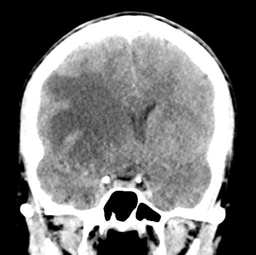 Cerebral abscess (Radiopaedia 60342-68008 Coronal non-contrast 26).png