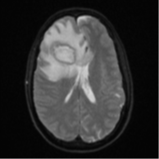 Cerebral abscess (Radiopaedia 60342-68009 Axial DWI 22).png