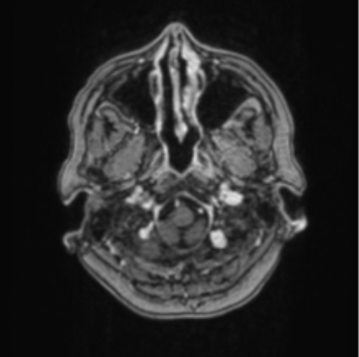 Cerebral abscess from pulmonary arteriovenous malformation (Radiopaedia 86275-102291 Axial T1 C+ 11).png