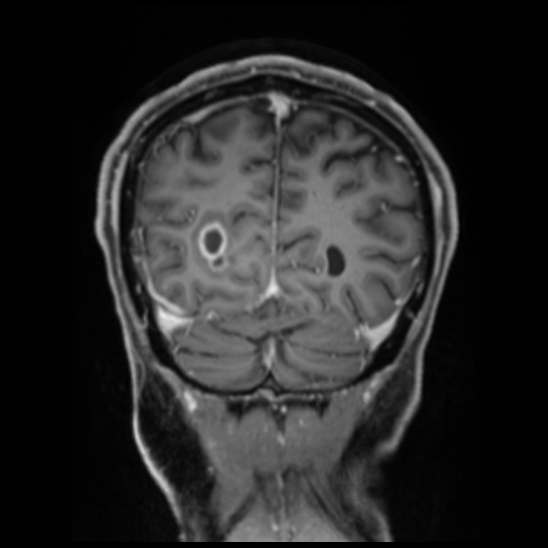Cerebral abscess with ventriculitis (Radiopaedia 78965-91878 Coronal T1 C+ 51).jpg