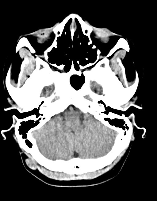 Cerebral abscesses (Radiopaedia 70458-80568 Axial non-contrast 16).jpg