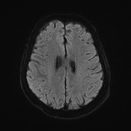 Cerebral amyloid angiopathy-related inflammation (Radiopaedia 74836-85849 Axial DWI 50).jpg
