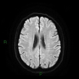 Cerebral amyloid angiopathy (Radiopaedia 77506-89664 Axial DWI 19).jpg
