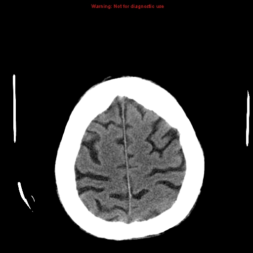 File:Cerebral and orbital tuberculomas (Radiopaedia 13308-13310 Axial non-contrast 24).jpg