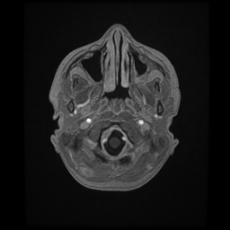 Cerebral and spinal tuberculosis (Radiopaedia 90489-107837 Axial T1 C+ 32).jpg
