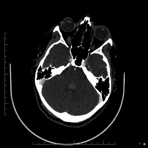 Cerebral arteriovenous malformation (AVM) (Radiopaedia 78162-90706 Axial CTA 90).jpg