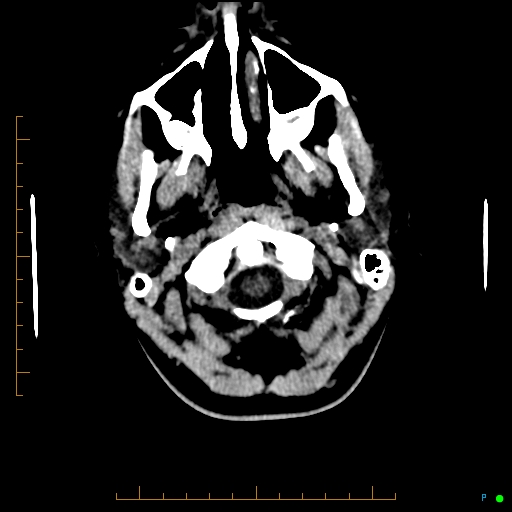 Cerebral arteriovenous malformation (AVM) (Radiopaedia 78162-90706 Axial non-contrast 6).jpg