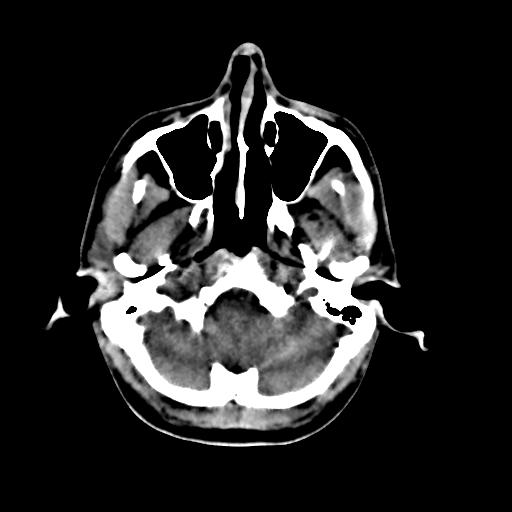 Cerebral arteriovenous malformation (Radiopaedia 28518-28759 Axial non-contrast 9).jpg