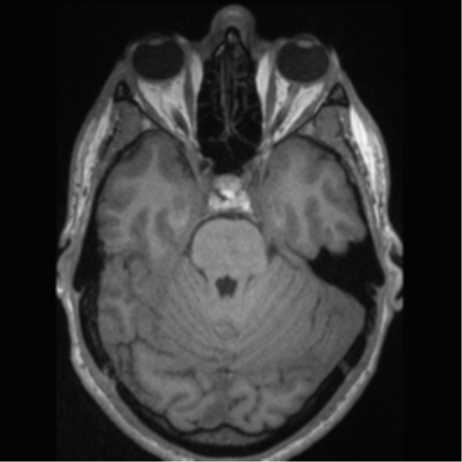 Cerebral arteriovenous malformation (Radiopaedia 55798-62372 Axial T1 19).png