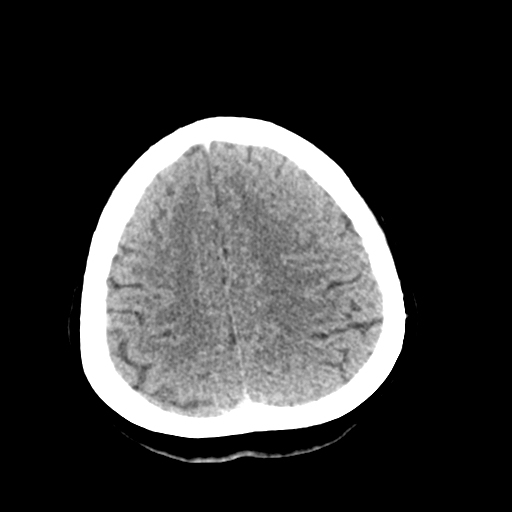 File:Cerebral arteriovenous malformation (Radiopaedia 73830-84645 Axial non-contrast 37).jpg