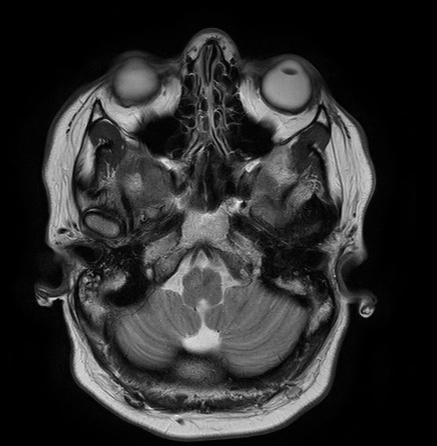 File:Cerebral arteriovenous malformation (Radiopaedia 74411-85654 Axial T2 3).jpg