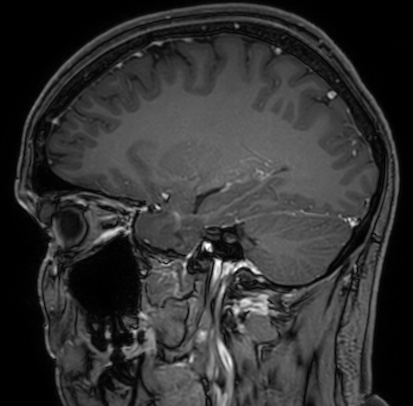 Cerebral arteriovenous malformation (Radiopaedia 74411-85654 Sagittal T1 C+ 41).jpg