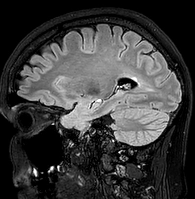 Cerebral arteriovenous malformation (Radiopaedia 74411-85746 Sagittal FLAIR 36).jpg