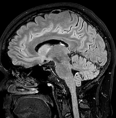 Cerebral arteriovenous malformation (Radiopaedia 74411-85746 Sagittal FLAIR 51).jpg