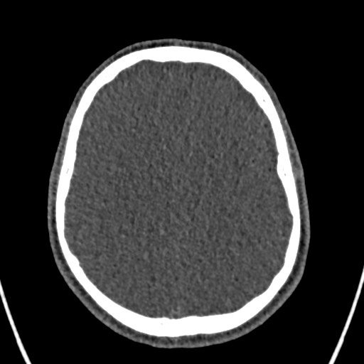 File:Cerebral arteriovenous malformation (Radiopaedia 78188-90746 Axial non-contrast 124).jpg