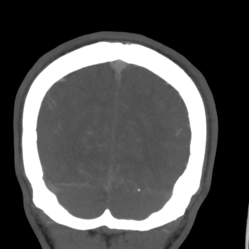 Cerebral arteriovenous malformation (Spetzler-Martin grade 2) (Radiopaedia 41262-44076 F 55).png