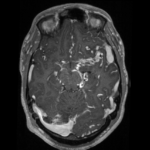 Cerebral arteriovenous malformation - huge (Radiopaedia 35734-37272 Axial T1 C+ 27).png