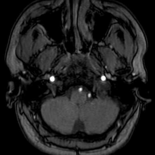 Cerebral arteriovenous malformation at posterior body of corpus callosum (Radiopaedia 74111-84925 Axial MRA 15).jpg