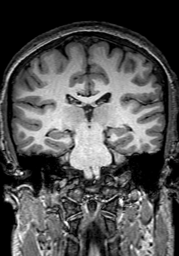 Cerebral arteriovenous malformation at posterior body of corpus callosum (Radiopaedia 74111-84925 Coronal T1 196).jpg