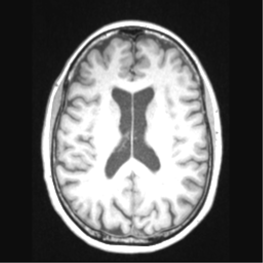 File:Cerebral arteriovenous malformation with hemorrhage (Radiopaedia 34422-35737 Axial T1 46).png
