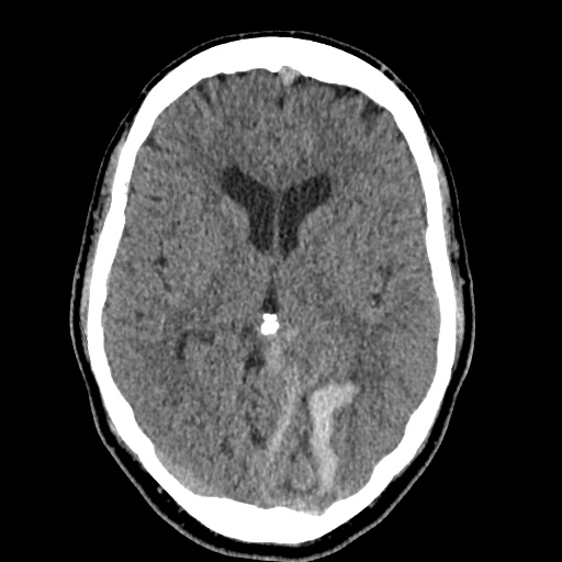 Cerebral arteriovenous malformation with lobar hemorrhage (Radiopaedia 35598-37117 Axial non-contrast 25).jpg