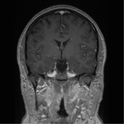 Cerebral cavernoma and development venous anomaly (Radiopaedia 37603-39482 Coronal T1 C+ 54).png