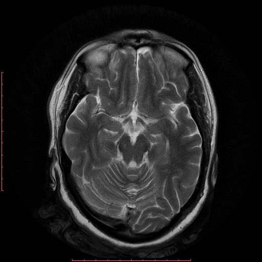 File:Cerebral cavernous malformation (Radiopaedia 26177-26306 Axial T2 9).jpg